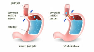 Žgaravica i refluks želuca